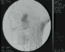 Angiofibroma nasofaringeo