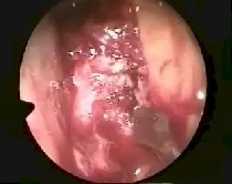 Angiofibroma nasofaringeo