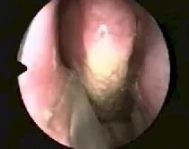 Angiofibroma nasofaringeo