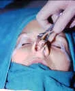 OPCIONES EN LA CIRUGIA DEL DORSO NASAL: Cirugía nasal complicada
