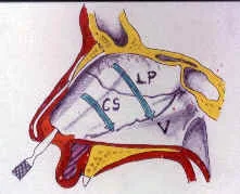 OPCIONES EN LA CIRUGIA DEL DORSO NASAL: Cirugía nasal complicada