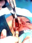 OPCIONES EN LA CIRUGIA DEL DORSO NASAL: Cirugía nasal complicada