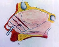 OPCIONES EN LA CIRUGIA DEL DORSO NASAL: Cirugía nasal complicada