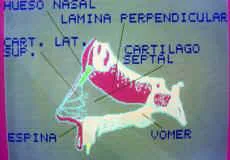 OPCIONES EN LA CIRUGIA DEL DORSO NASAL: Cirugía nasal complicada