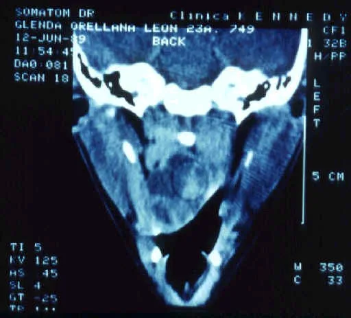 ANGIO FIBROMA NASOFARINGEO