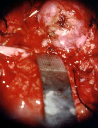 ANGIO FIBROMA NASOFARINGEO