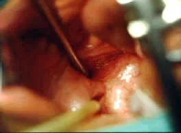 ANGIO FIBROMA NASOFARINGEO