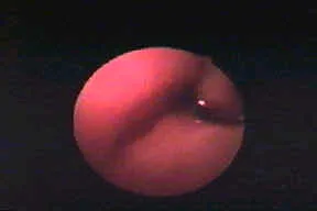 ANGIO FIBROMA NASOFARINGEO