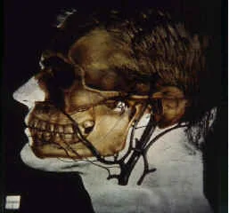 ANGIO FIBROMA NASOFARINGEO