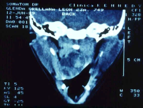 ANGIO FIBROMA NASOFARINGEO