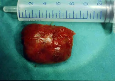 ANGIO FIBROMA NASOFARINGEO