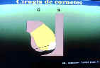CIRUGIA DE CORNETES