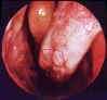 CIRUGIA DE CORNETES EN LA SEPTORRINOPLASTIA
