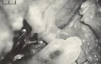 Dorello?s canal: a microanatomical study