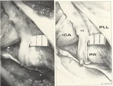 Dorello?s canal: a microanatomical study
