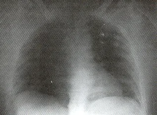 CONTUCIÓN PULMONAR