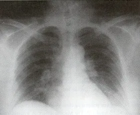 CONTUCIÓN PULMONAR