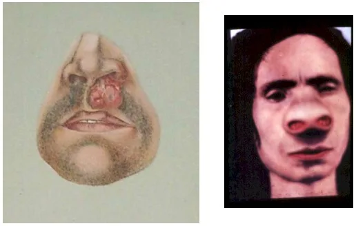 RINOESCLEROMA: CASO CLúnico