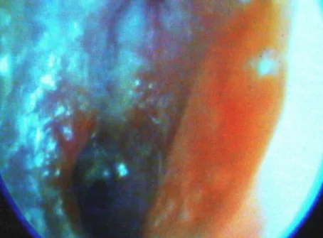 RINOESCLEROMA: CASO CLúnico