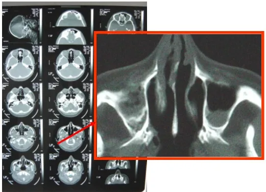 RINOESCLEROMA: CASO CLúnico