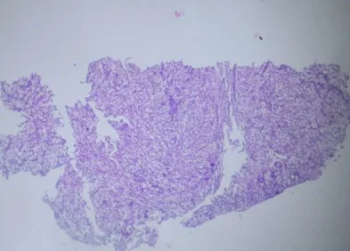 RINOESCLEROMA: CASO CLúnico
