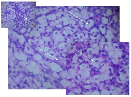RINOESCLEROMA: CASO CLúnico