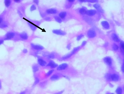 RINOESCLEROMA: CASO CLúnico