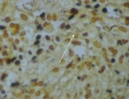 RINOESCLEROMA: CASO CLúnico