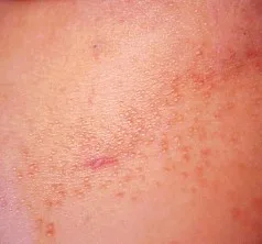 TUBERCULIDES: Que son Y CuálES SON