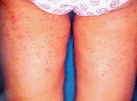 TUBERCULIDES: Que son Y CuálES SON