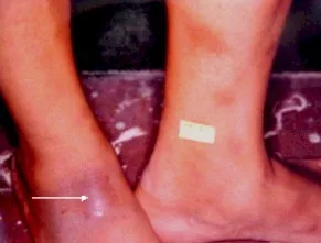 TUBERCULIDES: Que son Y CuálES SON
