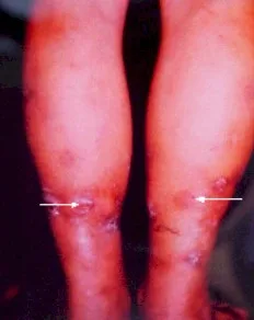 TUBERCULIDES: Que son Y CuálES SON