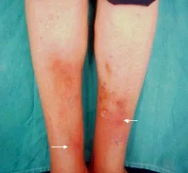 TUBERCULIDES: Que son Y CuálES SON