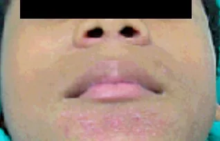 TUBERCULIDES: Que son Y CuálES SON