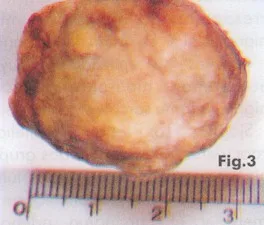 ENCEFALOPATIA TIROIDEA
