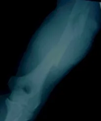 FRACTURA COMPLEJA DEL HUMERO