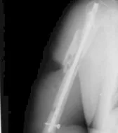 FRACTURA COMPLEJA DEL HUMERO