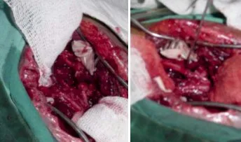 FRACTURA COMPLEJA DEL HUMERO