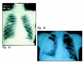 cáncer de Pulmón