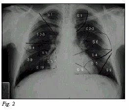 cáncer de Pulmón
