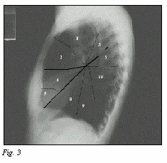 cáncer de Pulmón
