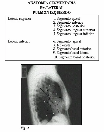 cáncer de Pulmón