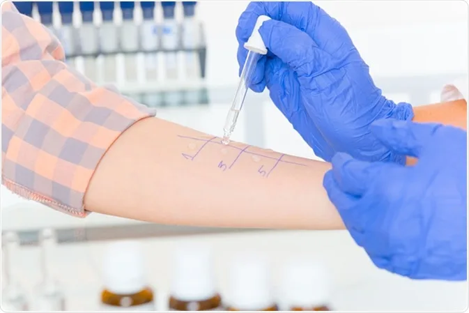 Imagen del artículo Pruebas de alergia
