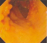 Cáncer colo-rectal y pólipos del colon y recto