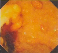 Cáncer colo-rectal y pólipos del colon y recto