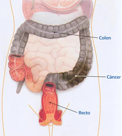 Cáncer colo-rectal y pólipos del colon y recto