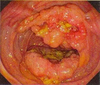 Cáncer colo-rectal y pólipos del colon y recto