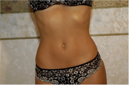 ABDOMINOPLASTIA GUAYAQUIL