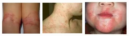 Imagen del artículo DERMATITIS ATOPICA