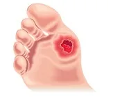 Imagen del artículo PIE DIABETICO